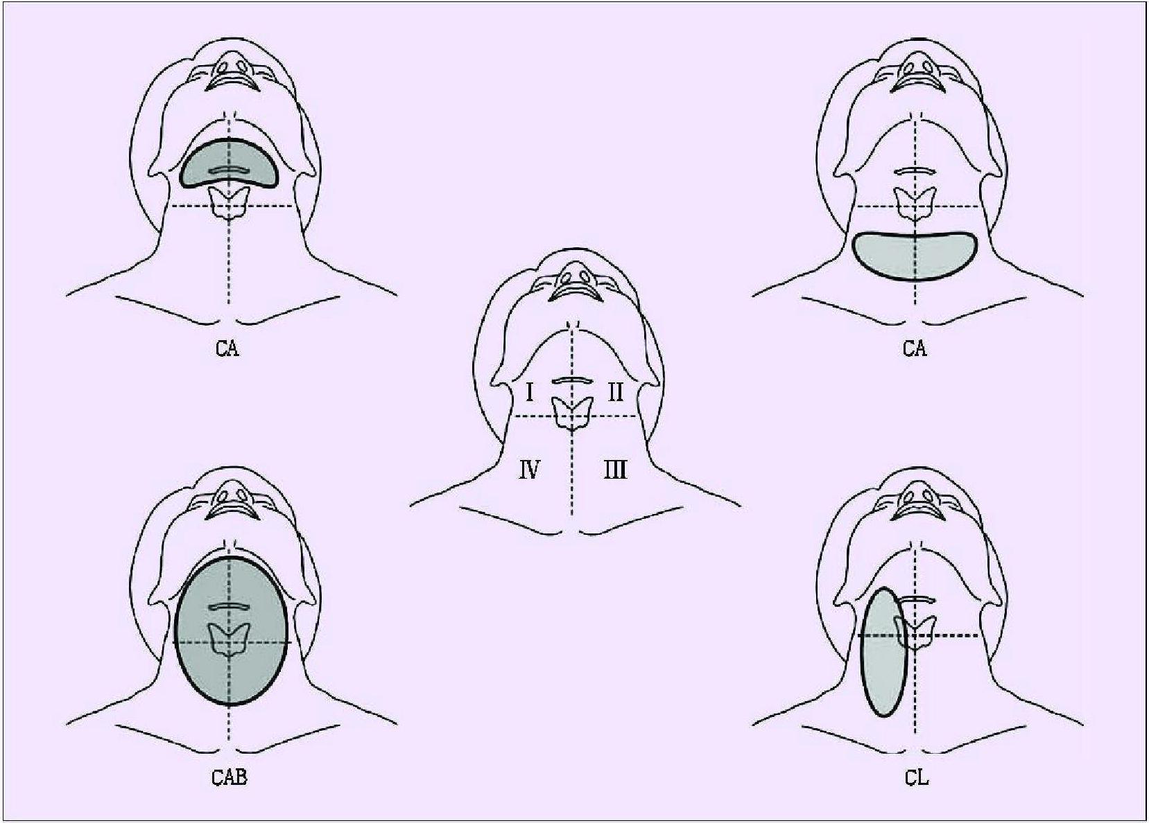 一、頸部燒傷瘢痕畸形的分類(lèi)和評(píng)估